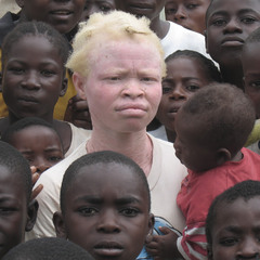 Женщина - альбинос